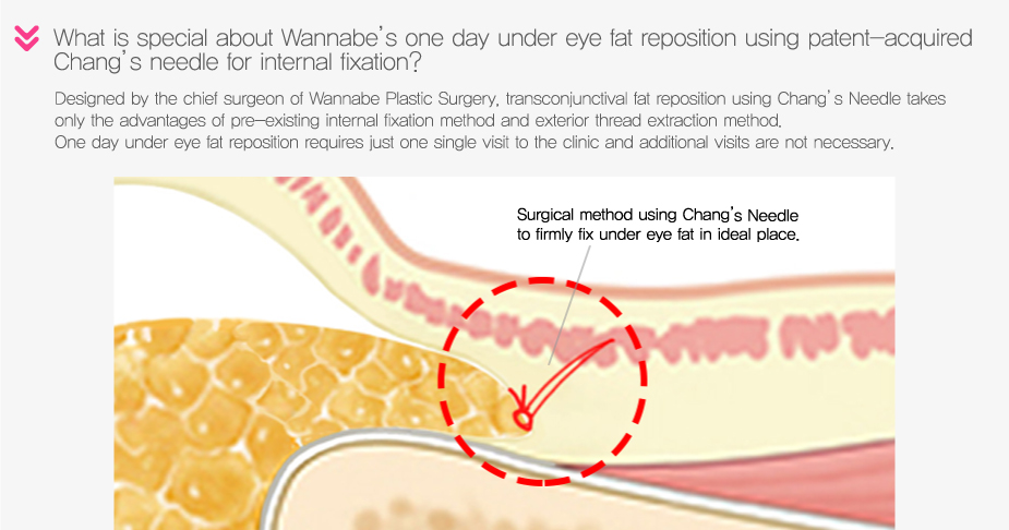 What is special about Wannabe's one day under eye fat reposition using patent-acquired Chang's needle for internal fixation?