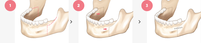 Lower Jaw Surgery Surgery Method